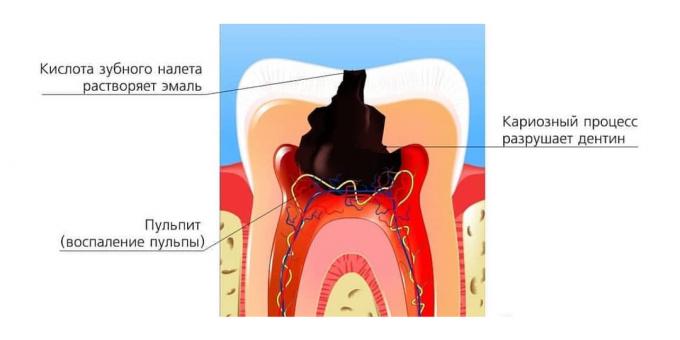Hvad er huller i tænderne