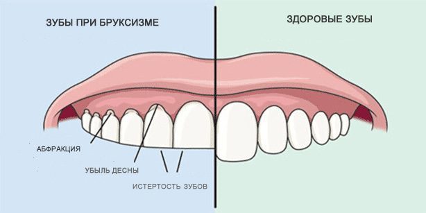 Tænder slibning: Sunde tænder og tænder under bruxism