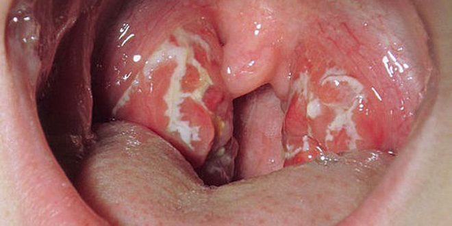 symptomer på tonsillitis