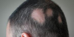 Alopecia: hvorfor du mister hår, og hvordan man behandler det