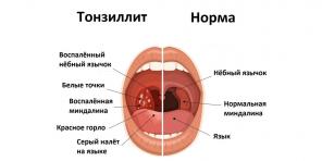 Kronisk tonsillitis: symptomer, komplikationer, behandling og mere