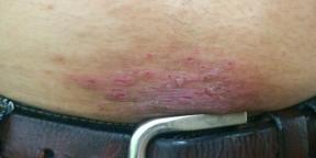 Hvordan ser dermatitis ud, og hvad skal man gøre, hvis man har noget lignende