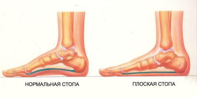 øvelser til flade fødder: normal og flad fod