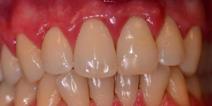 Hvorfor blødende tandkød og hvad de skal gøre