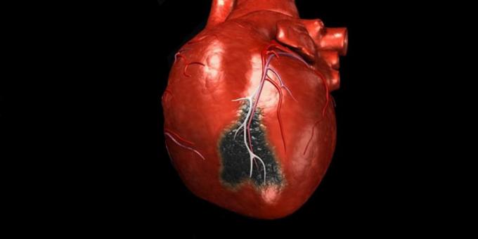 Symptomer på et hjerteanfald, som du har brug for at ringe efter en ambulance