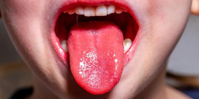 Scarlet feber symptomer: Strawberry Tongue