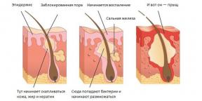 Hvordan at slippe af Acne: Den mest omfattende guide